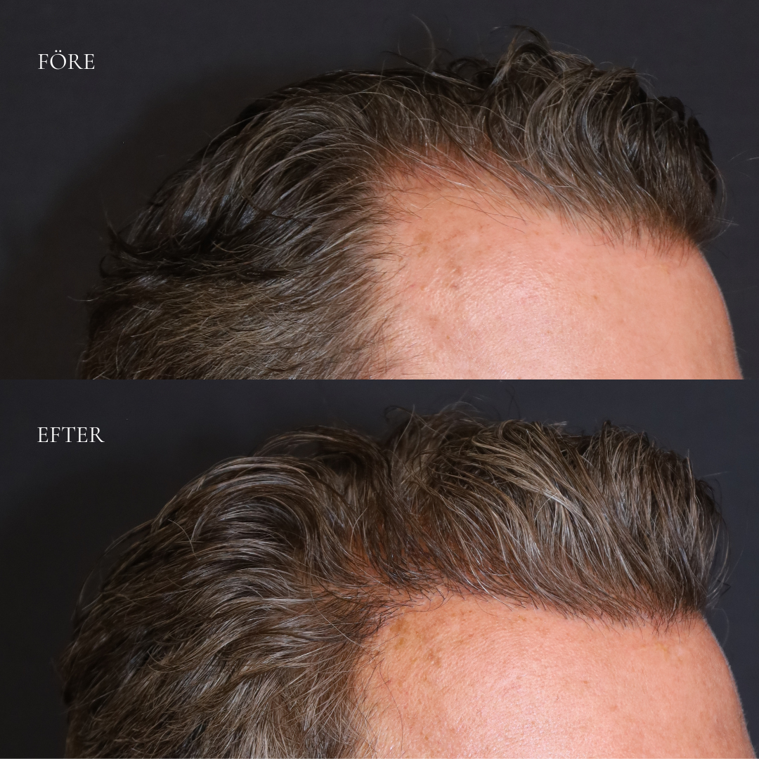 Before and After Photos of Hair Transplant Results with the DHI Technique